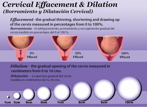 dilation and effacement