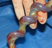 umbilical cord full of blood